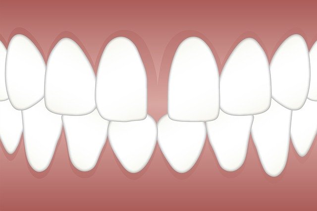 Diastema - Zahnluecke